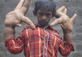 ८ वर्षीय बालकका १६ किलोका हात !!!