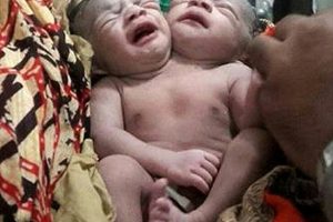 जन्मिइन् दुर्इ टाउको भएकी बालिका, शरीर एउटै