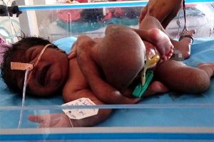 चार हात, चार खुट्टा भएको बच्चाको जन्म