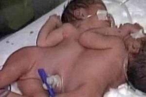 जोडिएका जुम्ल्याहा बच्चाको जन्म, दुवैको एउटै कलेजो