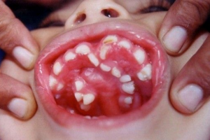 कस्तो रोग ९ बर्षिय बच्चाको मुखमा ३०० बढि दाँत, जानिराखौ