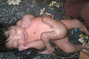 चार खुट्टा र दुई लिंगसहित जन्मेका बच्चाले पाए पुर्नजीवन, शल्यक्रिया सफल