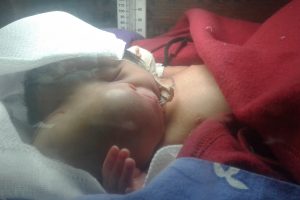 आमाको पेटमै ट्यूमर भएको अनौठो शिशुको जन्म