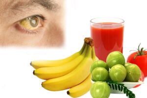 जन्डिस भएमा के कुरा खान हुन्छ, के खानेकुरा बार्नुपर्छ ?