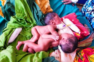 सप्तरीकी दुखनीदेवीले कोसी अस्पतालमा जन्माइन छाती जोडिएका जुम्ल्याहा