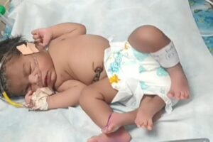 महिलाले जन्म दिइन् ४ खुट्टा भएकी छोरी, भवानको आगमन भन्दै नवजात शिशु हेर्नहरूकाे भीड